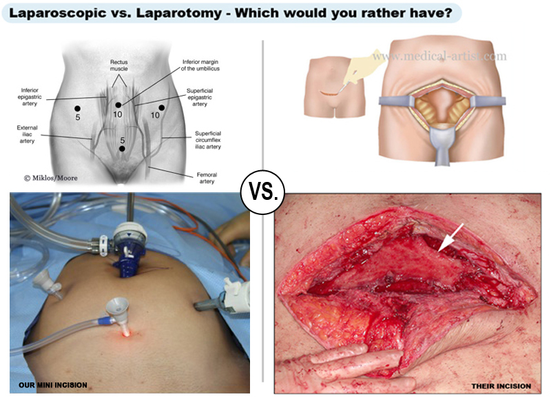 Neovagina incisions