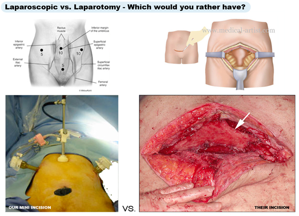laparoscopy vs. laparotomy - which would you rather have?